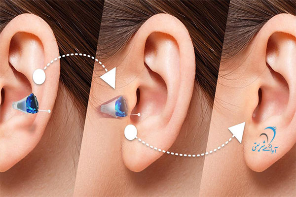 کلینیک آوای شریعتی-سمعک - Silk hearing aid 